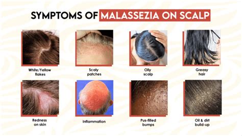Visual representation of Malassezia yeast on the scalp and its effect on hair follicles.