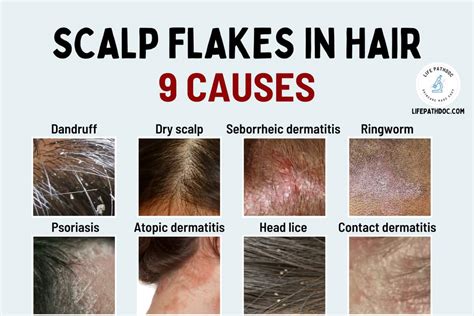 Collage of images representing different causes of itchy scalp: dandruff flakes, psoriasis patches, ringworm, head lice.
