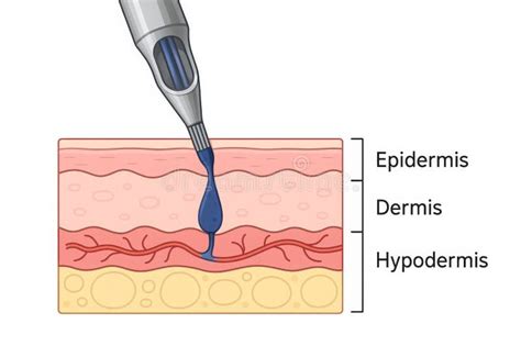 Diagram showing a chigger injecting enzymes into the skin