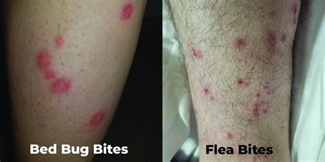 Side-by-side comparison of a chigger and a bedbug