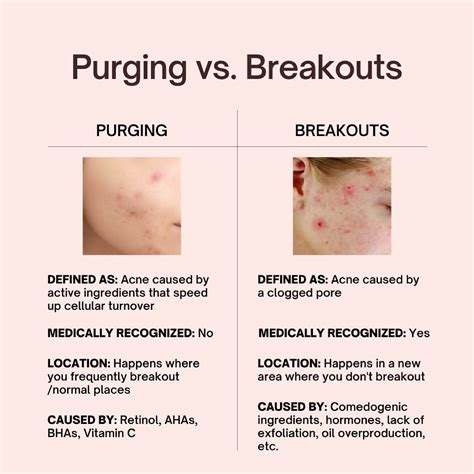 Diagram illustrating the difference between skin purging and a typical breakout, showing healing timelines and locations.