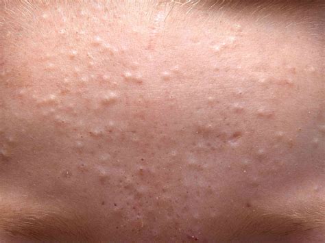 Close-up, high-quality photograph of skin texture showing small bumps and comedones characteristic of acne cosmetica.