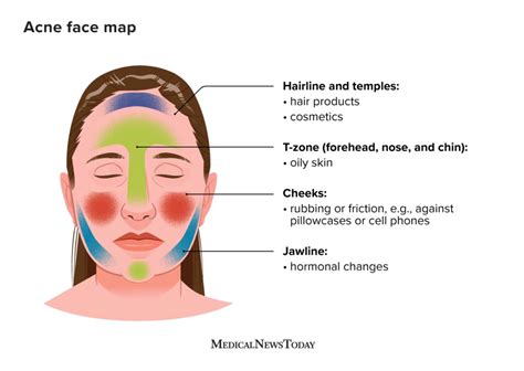 Illustration showing the typical pattern of perioral acne breakouts around the lips, chin, and jawline.