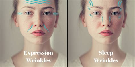 Diagram showing the difference between sleep wrinkles and expression wrinkles.