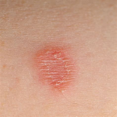 Illustration of a typical ringworm rash on skin, showing a circular, red, and scaly appearance with central clearing.
