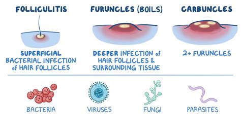 Diagram illustrating the progression of bacterial skin infections: folliculitis, furuncle, and carbuncle, highlighting their appearance and relation to hair follicles.