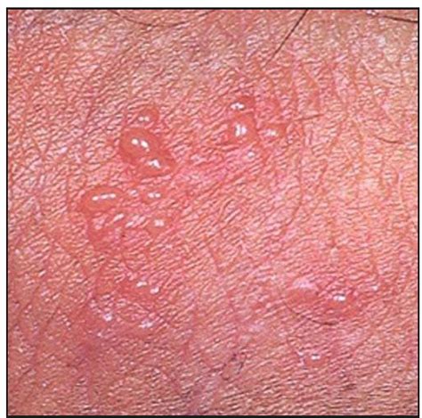 Close-up image of herpes gladiatorum lesions, showing clusters of fluid-filled vesicles on an inflamed base.