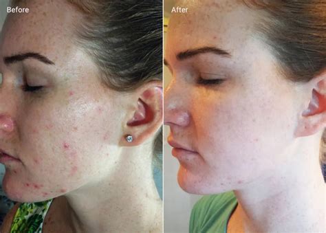 Before and after photos showcasing the results of microdermabrasion on various skin concerns.