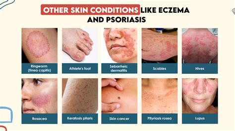 Infographic illustrating common skin conditions like acne, eczema, psoriasis, and rosacea, with brief descriptions of treatments.