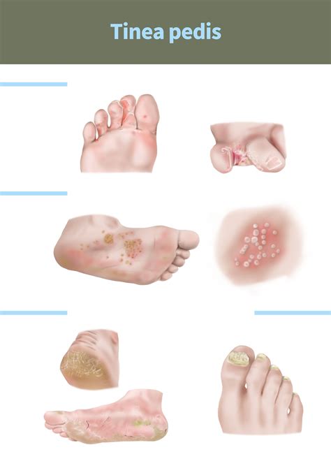 Diagram illustrating the different forms of tinea pedis: interdigital, moccasin, and vesiculobullous.