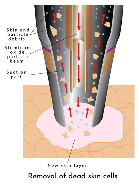 Diagram illustrating the process of microdermabrasion, showing the diamond-tipped wand exfoliating the skin and a vacuum suctioning away dead cells.