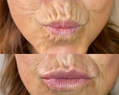 Infographic illustrating the causes of lip lines, including aging, sun exposure, and repetitive facial movements.