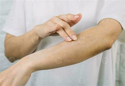 Image of a person applying a thin layer of cream to an eczematous patch on their arm.