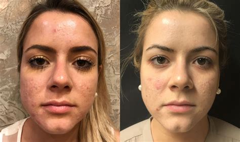 Before and after photos showcasing microneedling results for acne scars and wrinkles