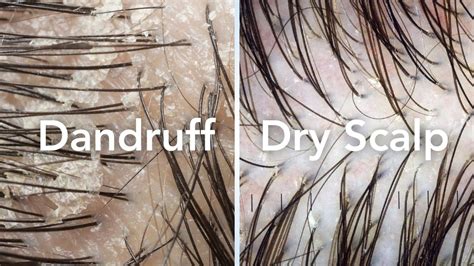 Side-by-side comparison of a healthy dog coat and a coat with visible dandruff and flakes