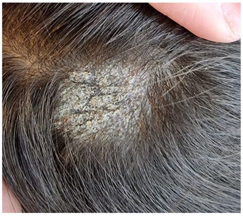 Image of a scalp showing characteristic signs of tinea capitis, including scaly patches and hair breakage.