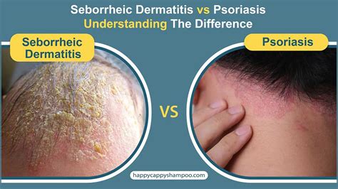 Comparison table showing key differences between fungal scalp infections, seborrheic dermatitis, and psoriasis.
