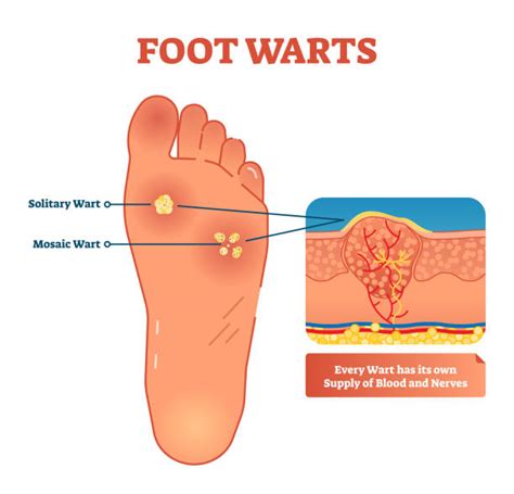 Illustration of a plantar wart on the sole of a foot, highlighting its location and appearance.