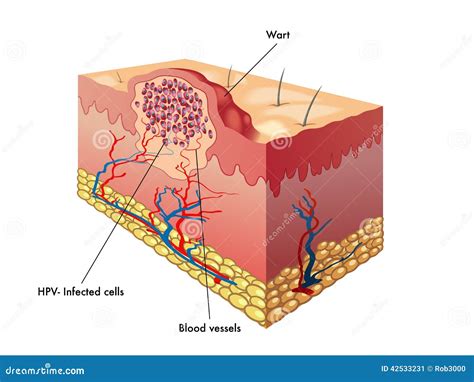 Diagram illustrating how laser energy targets blood vessels within a wart.