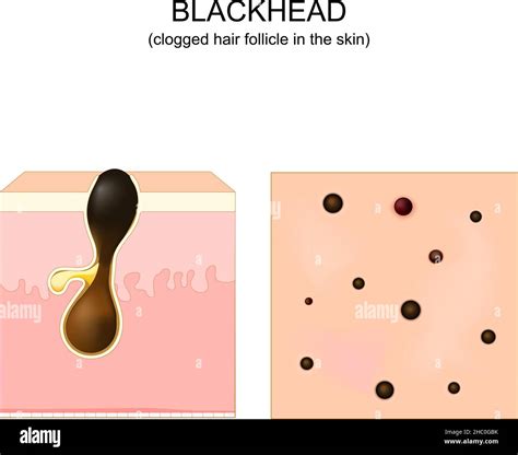 Illustration showing the cross-section of a clogged hair follicle forming a blackhead