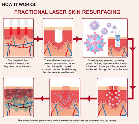 Diagram illustrating how a fractional laser works on skin layers.