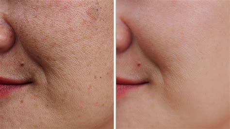 Split image showing before and after results of various dark spot treatments.