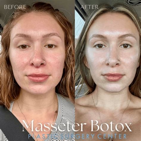 Before and after images illustrating facial slimming results from Masseter Botox.