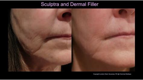 Before and after comparison of Sculptra treatment for jowls