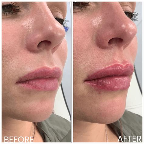 A close-up photo of lips before and after filler injections, showcasing increased volume and improved shape.