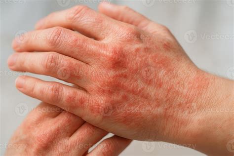 Close-up photograph showing the characteristic red, inflamed patches of eczema on facial skin.
