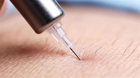 Close-up of a fine needle injecting into facial skin