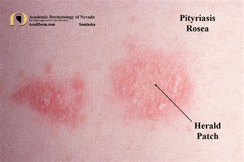 Illustration of the herald patch of pityriasis rosea