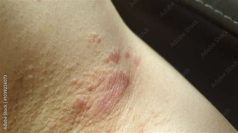 Close-up image of a ringworm rash on skin