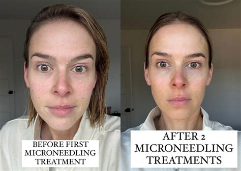 Before and after photos of microneedling results