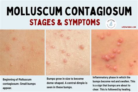 Illustration showing common locations of molluscum contagiosum papules on the body.