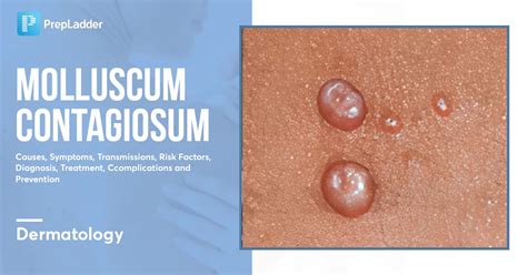 Infographic illustrating different modes of molluscum contagiosum transmission.