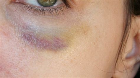 Close-up of a person’s face showing minor bruising and swelling at the injection site after receiving Botox.