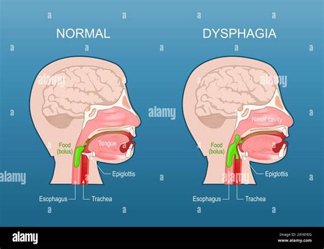 Illustration showing the muscles of the throat and esophagus, with an indicator of potential difficulty swallowing.