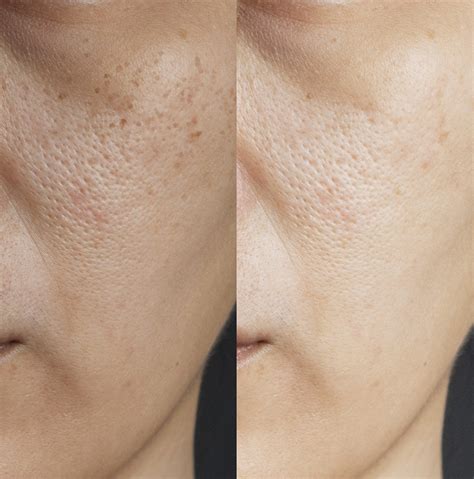 Split image showing dull, rough skin on the left and smoother, glowier skin on the right after Vanicream application.