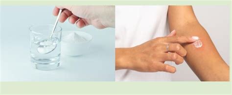 Illustration showing a person applying a baking soda paste to a mosquito bite on their arm.