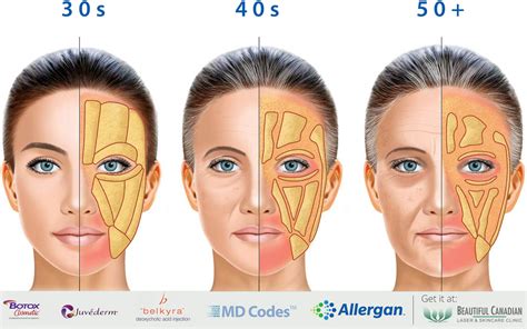 Diagram showing the process of fat transfer for facial rejuvenation.