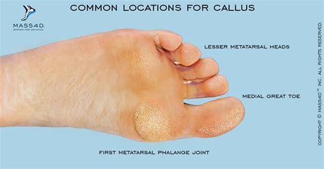 Diagram illustrating the common locations of callus formation on the foot.