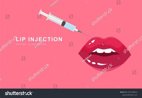 Illustration of the lip injection process.