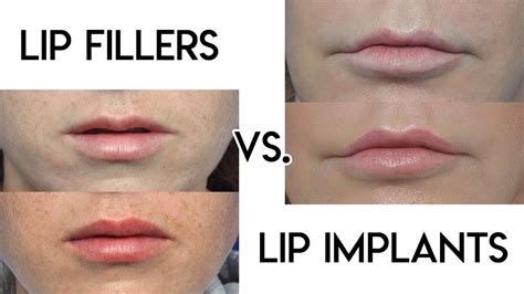 Visual comparison of lip implants and lip fillers.