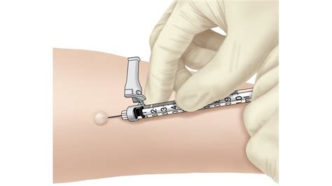 Illustration showing the procedure for a TB skin test, including PPD injection and measurement of the reaction site.
