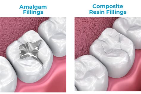 Diagram illustrating how amalgam particles can become lodged in gum tissue during dental filling placement.