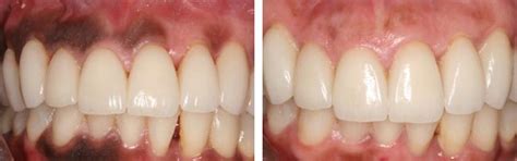 Image showing the difference in gum pigmentation between a smoker and a non-smoker.