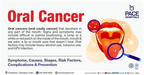 Illustration highlighting common areas where oral cancer may appear, including the gums.
