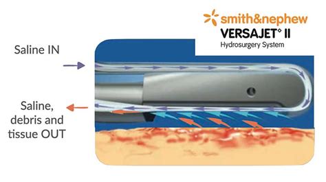 Illustration of the Versajet hydrosurgery system used for wound debridement.