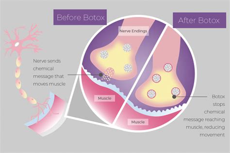 Diagram illustrating how Botox blocks nerve signals to relax muscles and smooth wrinkles.